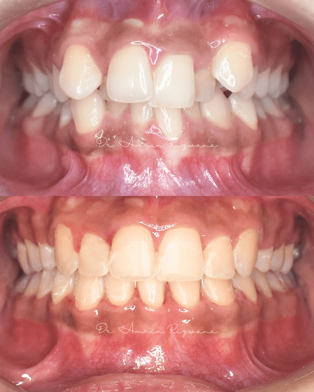 Intraoral clinical photographs from orthodontic patient case 01