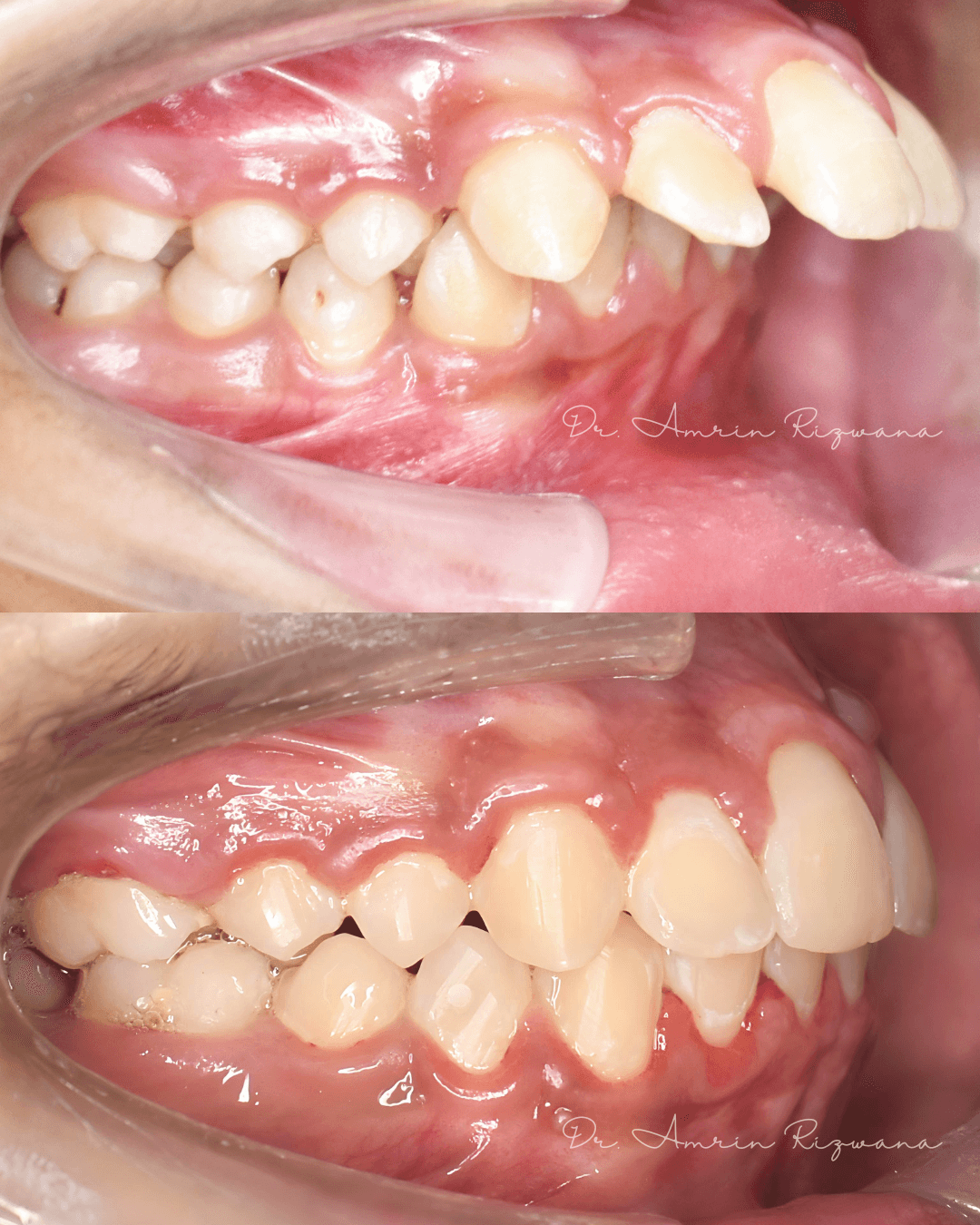 Intraoral clinical photographs from orthodontic patient case 02