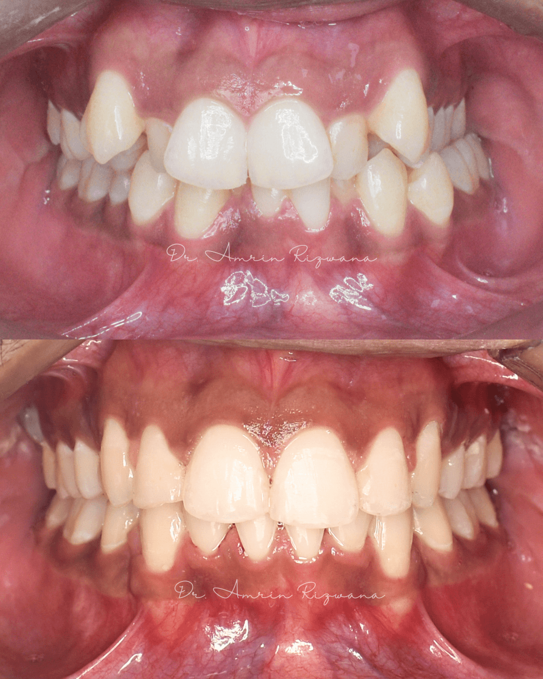 Intraoral clinical photographs from orthodontic patient case 03