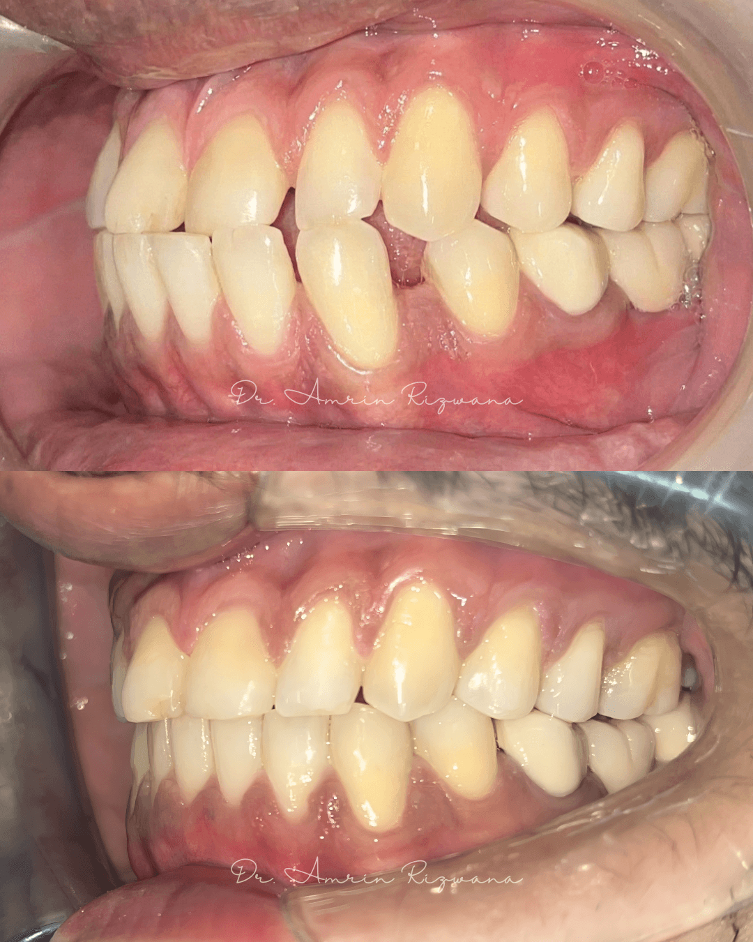 Intraoral clinical photographs from orthodontic patient case 04
