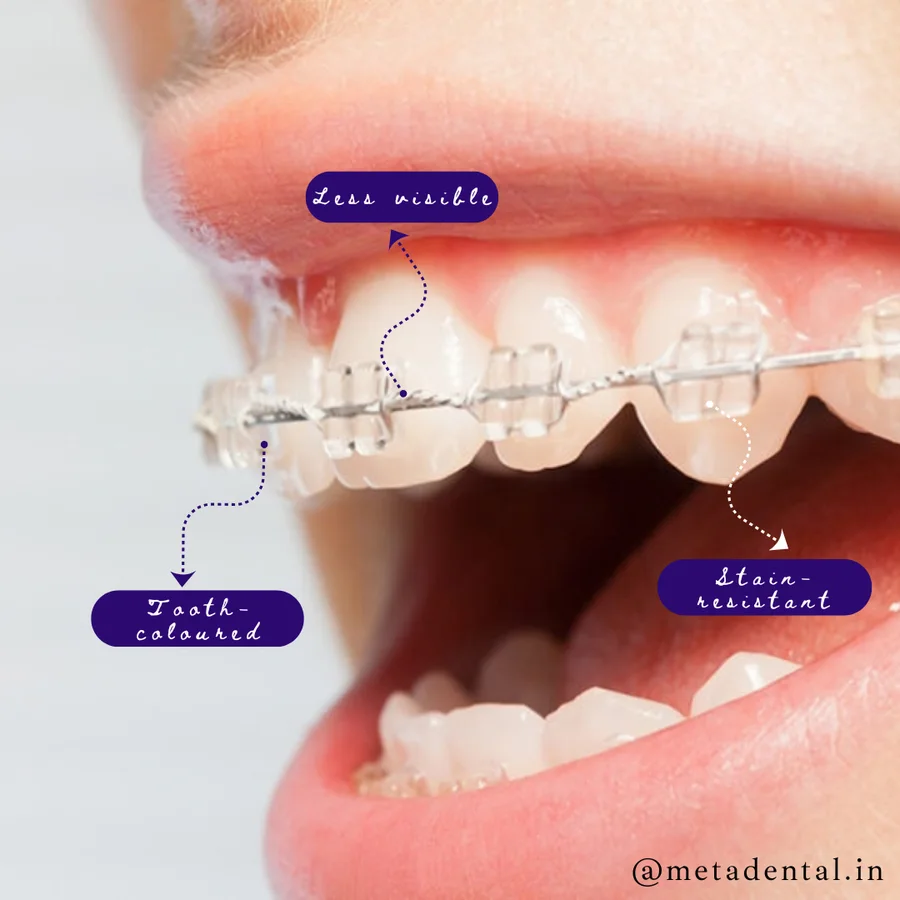 Ceramic braces on teeth