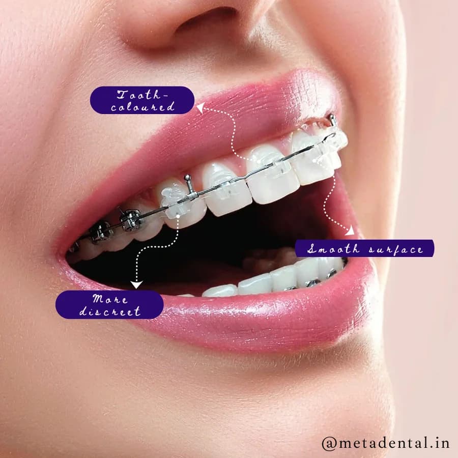 Damon ceramic braces on teeth