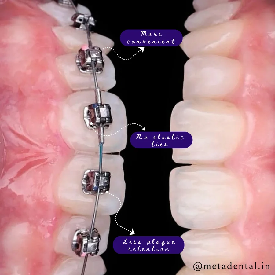 Damon metal braces on teeth