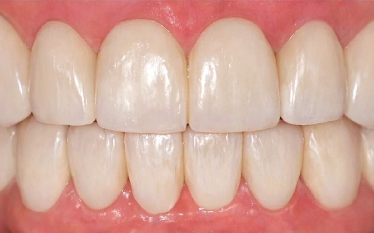 Restored smile following individual dental care