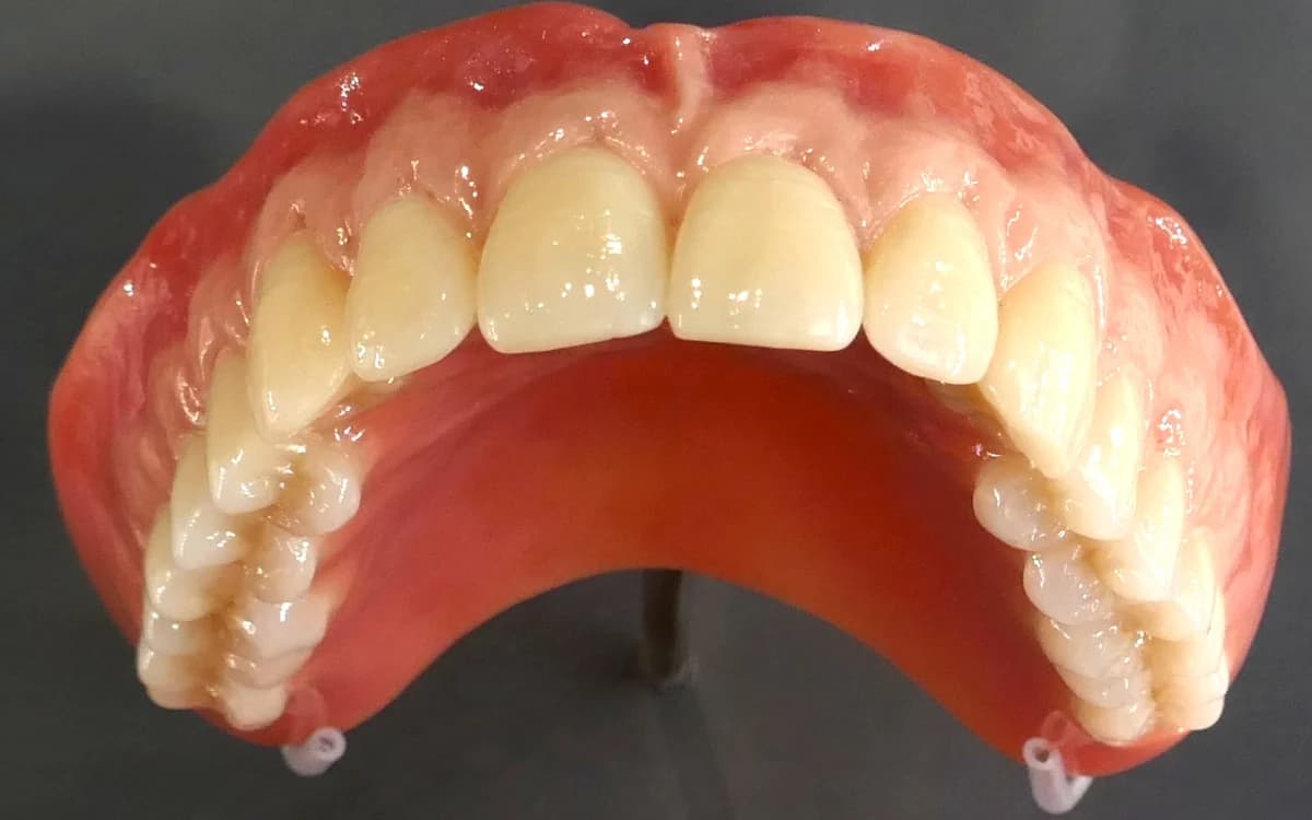 Complete acrylic denture used to replace missing teeth