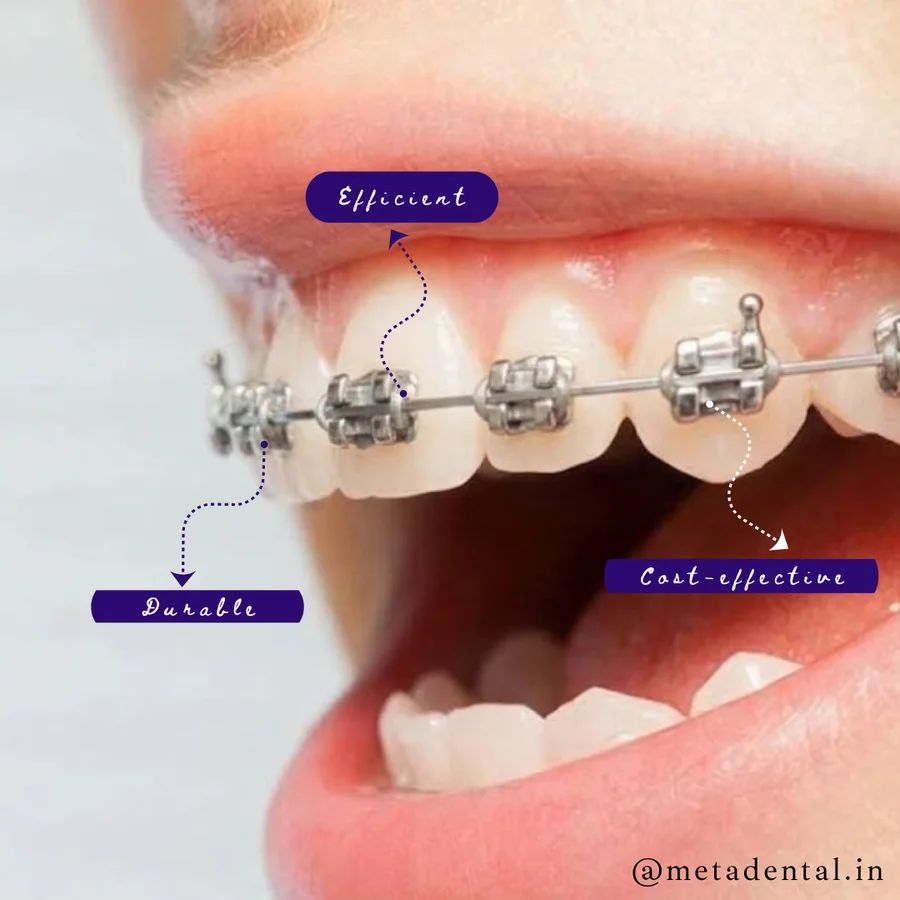 Metal braces used for orthodontic treatment