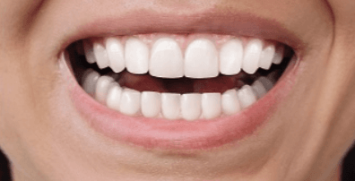 Teeth after aligner treatment
