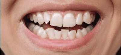 Teeth before aligner treatment