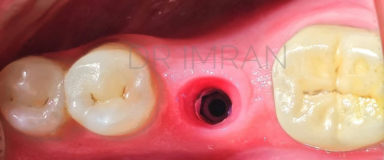 Intraoral clinical view of a dental implant component at a tooth-replacement site