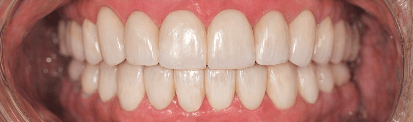 Smile after restorative cosmetic treatment