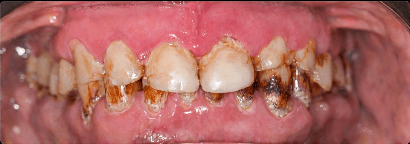 Smile before restorative cosmetic treatment